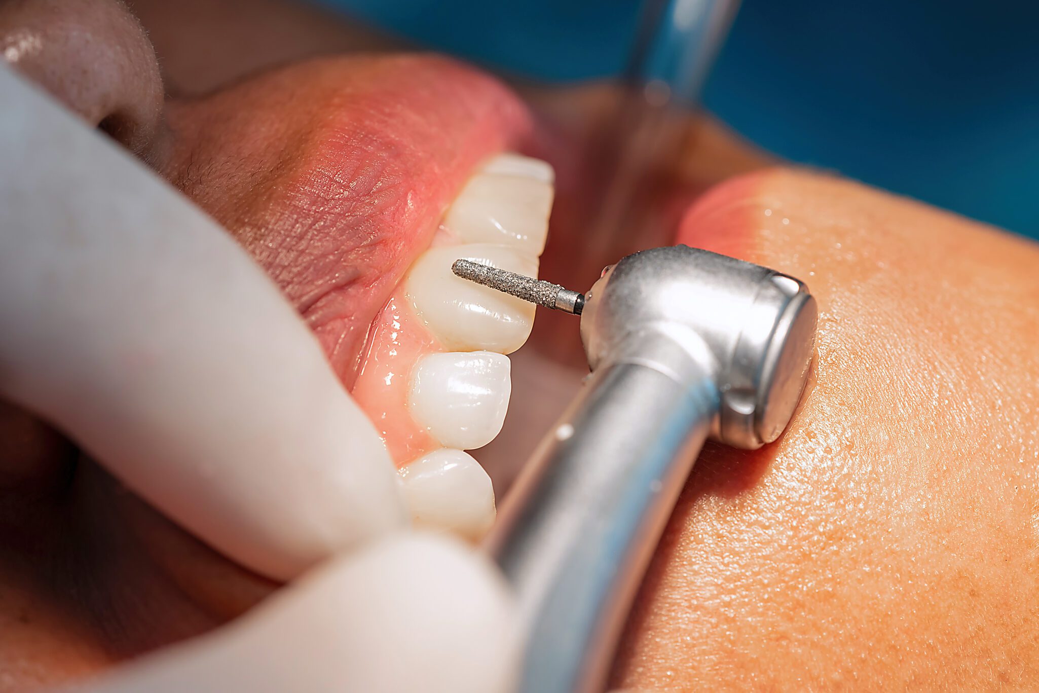 chipped or discolored teeth Cosmetic Dentistry in Kill Devil Hills